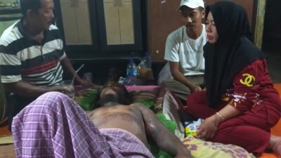 Sepeda Motor Ditabrak, Tubuh Pedagang Bakso Melepuh Tersiram Air Mendidih